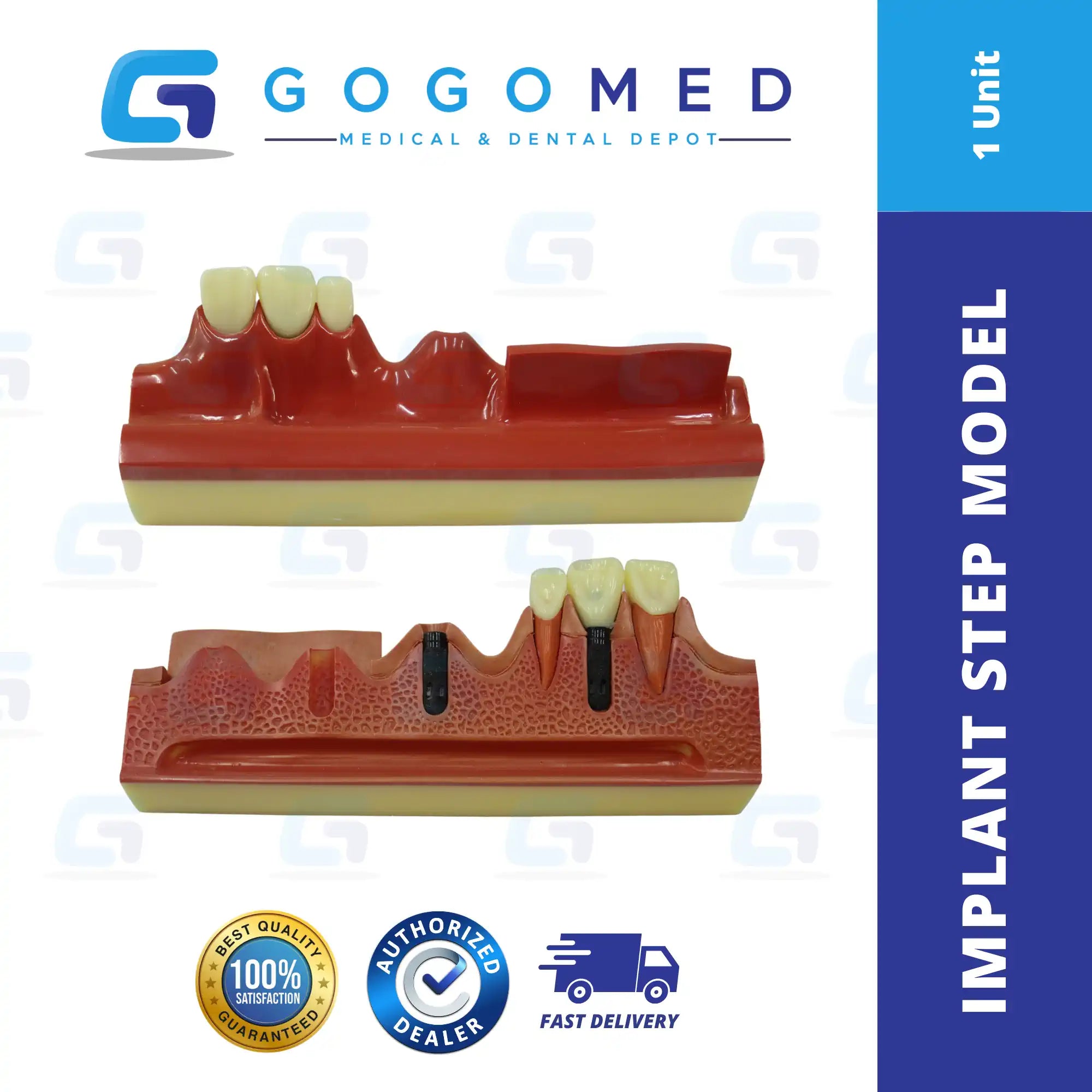 Implant Step