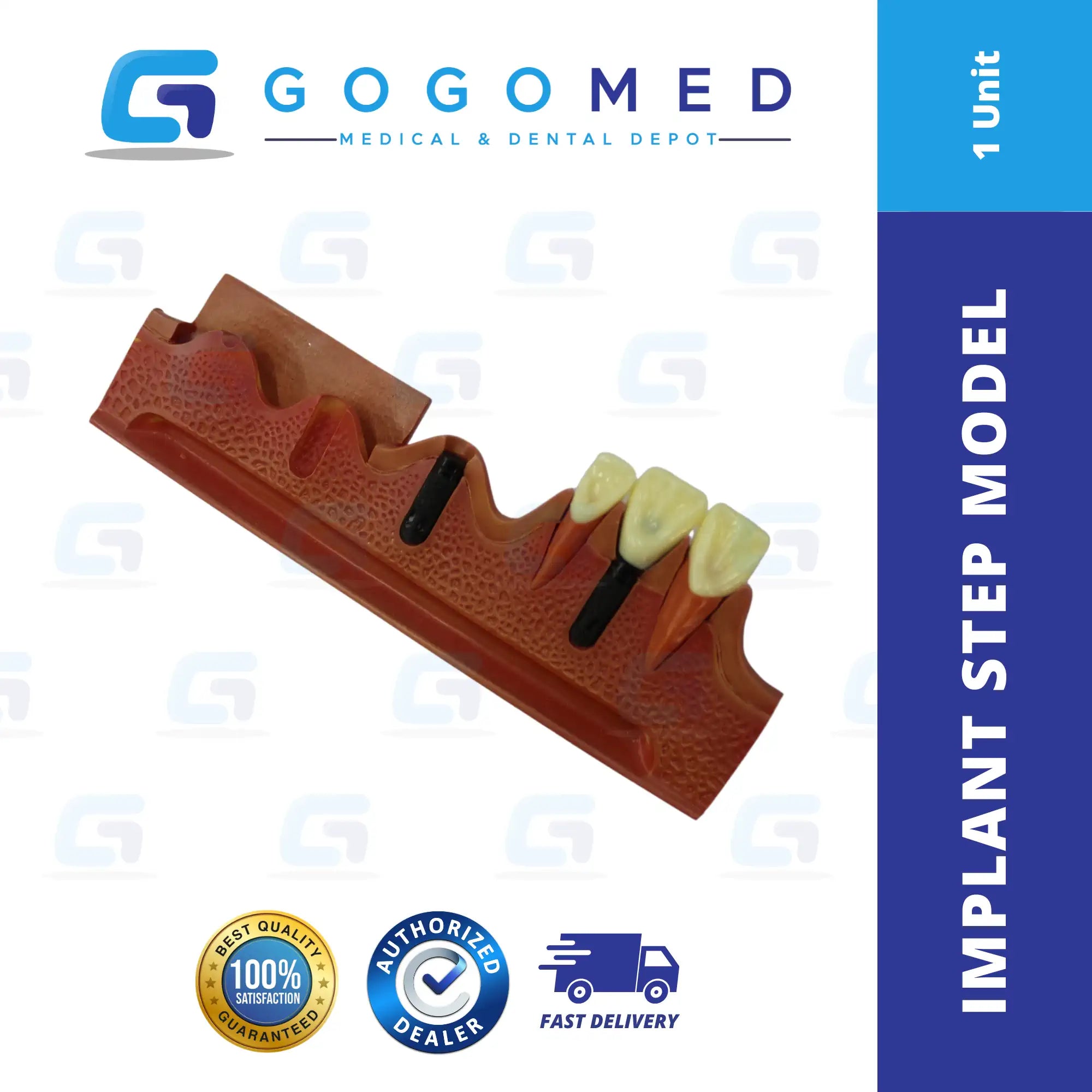 Implant Step