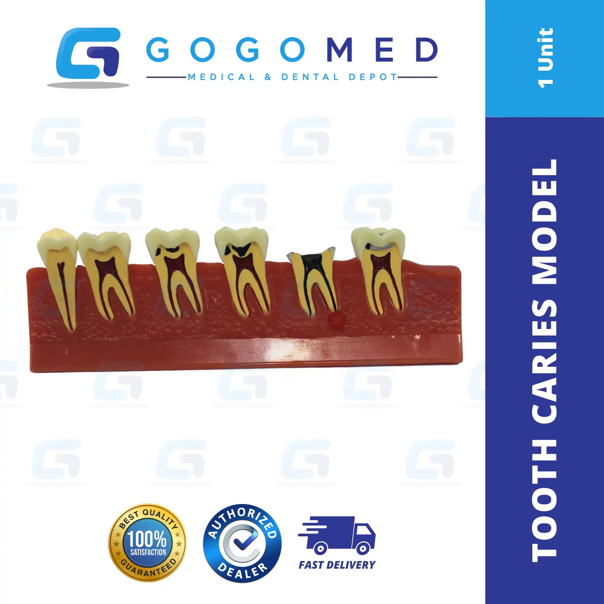 Tooth Caries Model