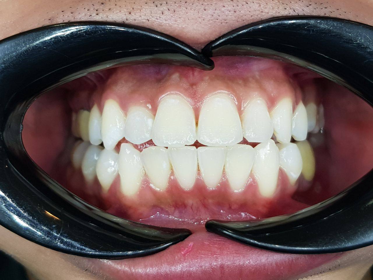 HiTeeth Complete Whitening Kit (HP25)