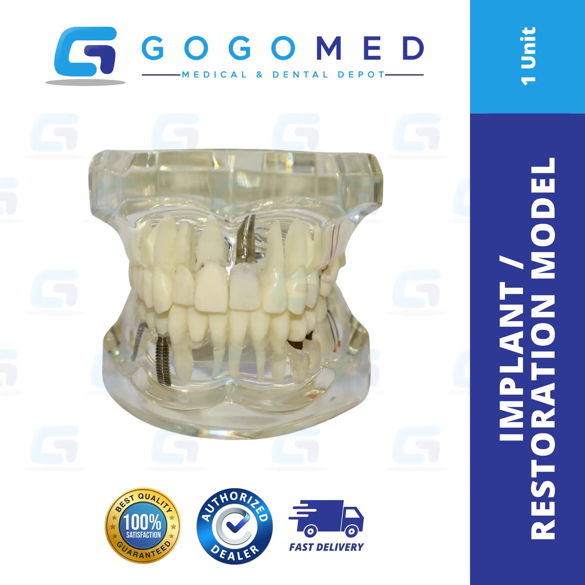 Implant / Restoration Model