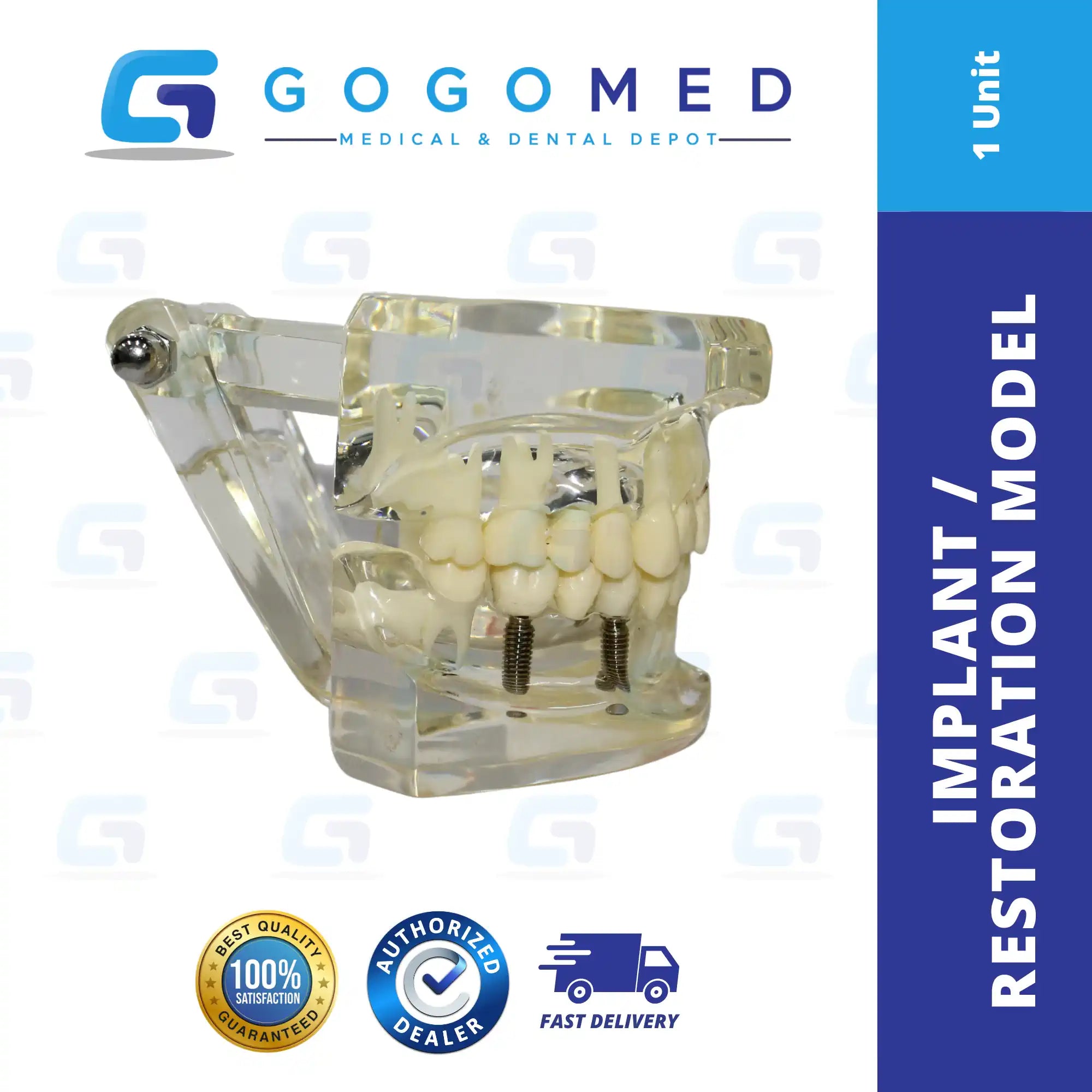 Implant / Restoration Model