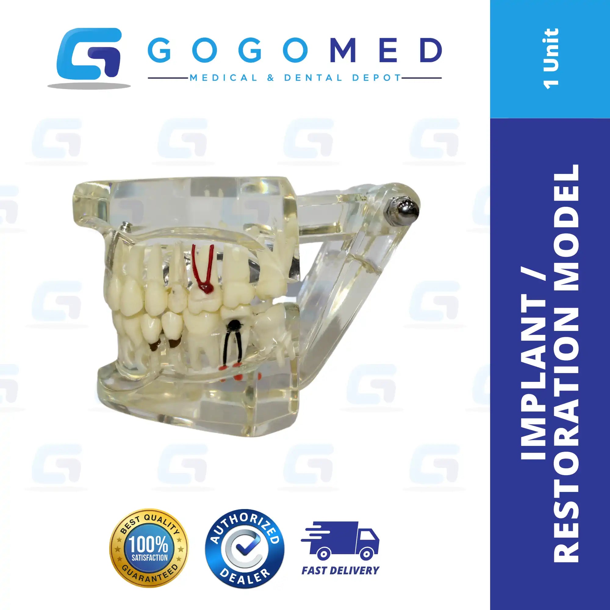 Implant / Restoration Model