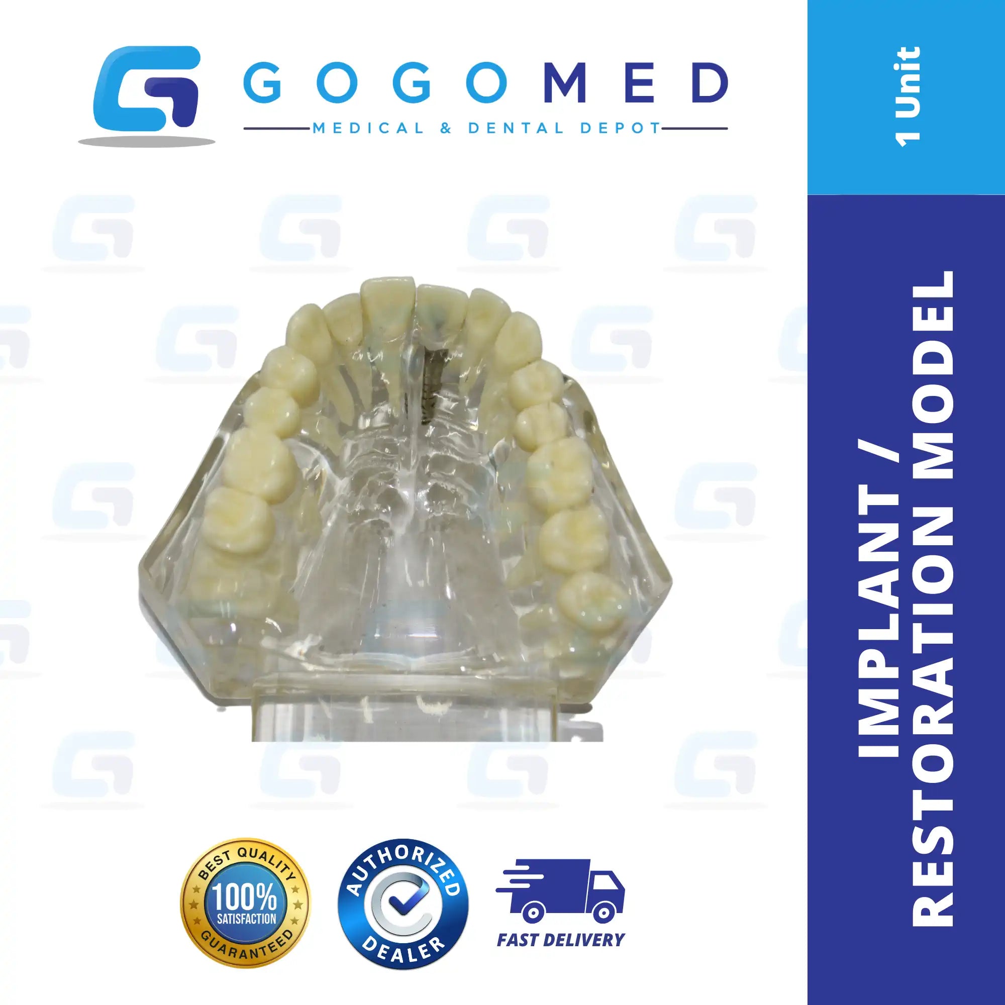Implant / Restoration Model