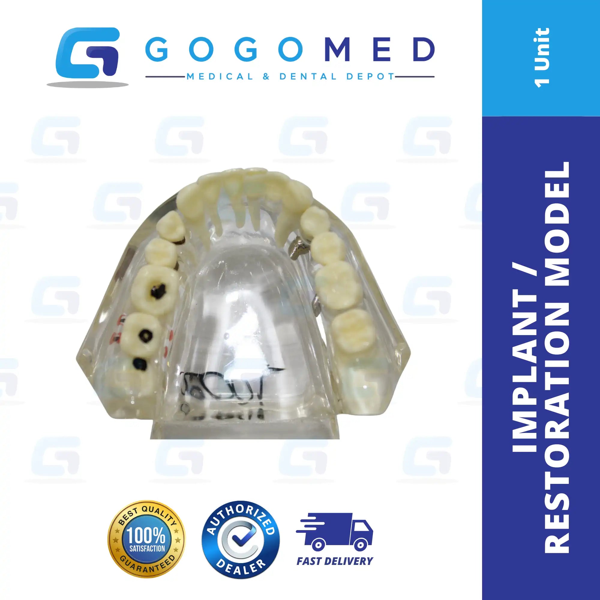 Implant / Restoration Model