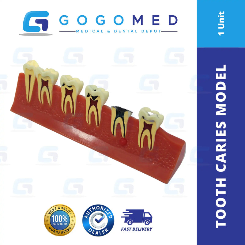 Tooth Caries Model