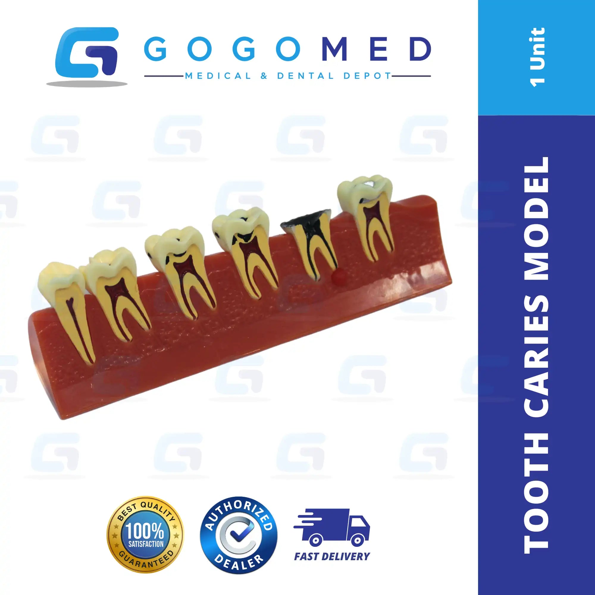 Tooth Caries Model