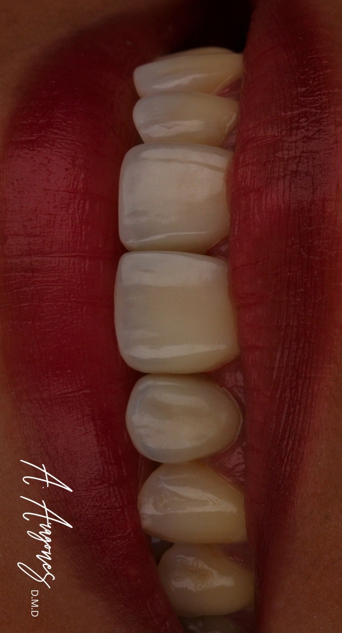 Yamakin TMR-Z Fill  Composite