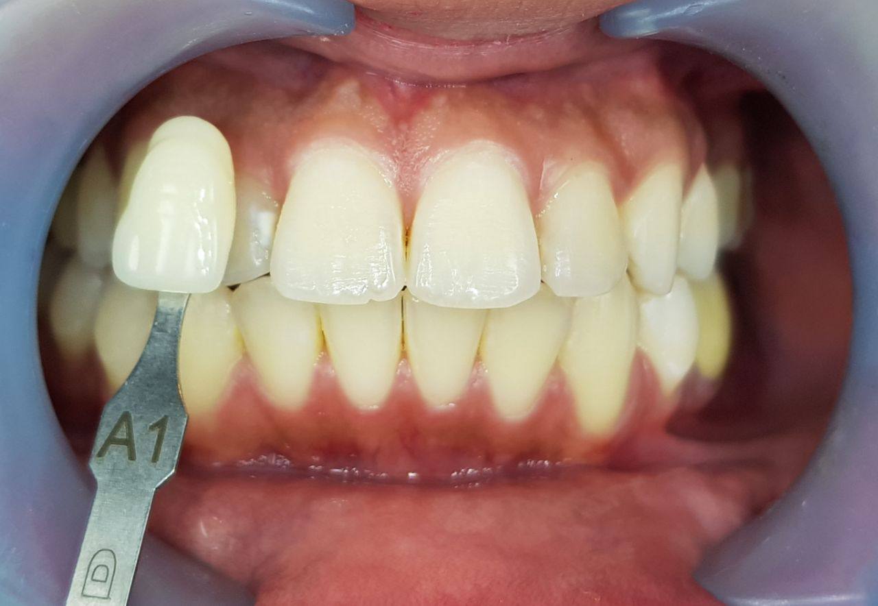 HiTeeth Complete Whitening Kit (HP25)