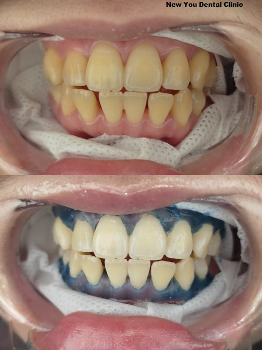 Smilin' Whitening System Kit