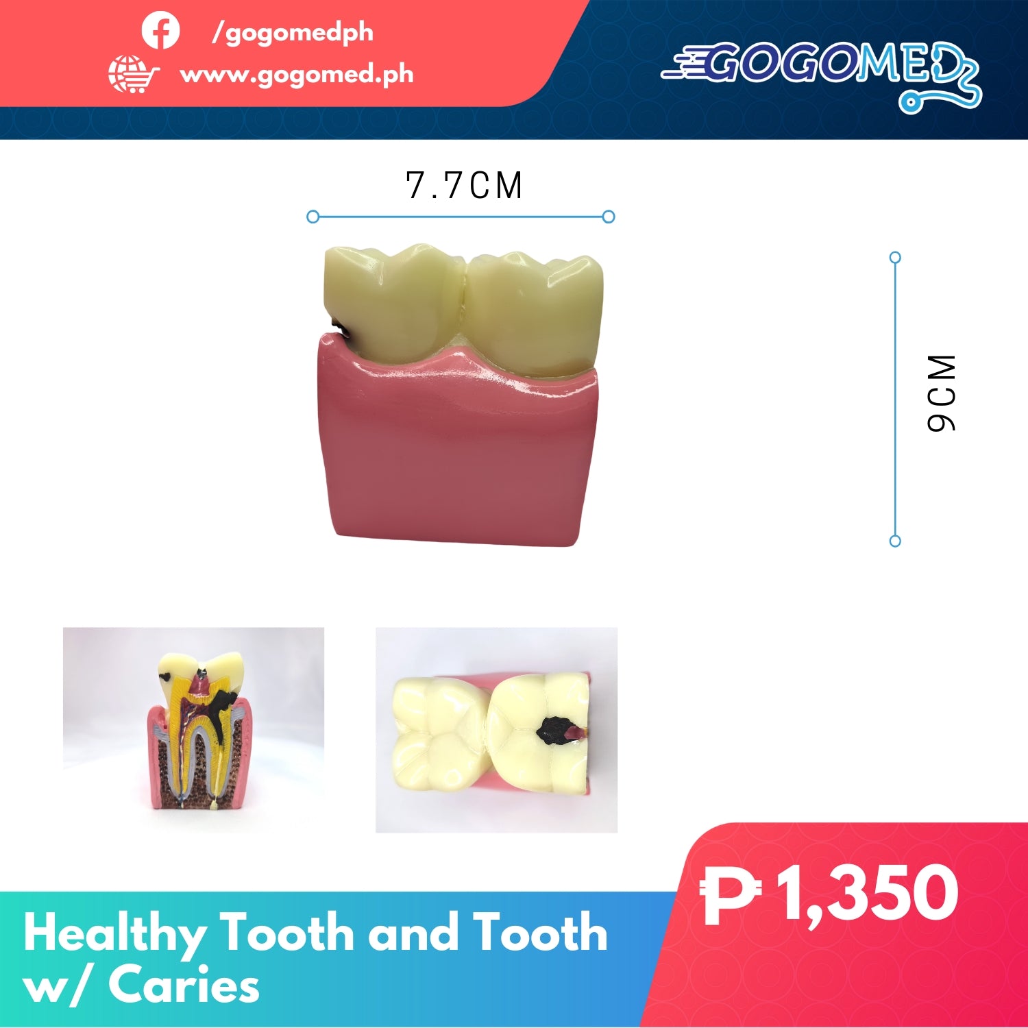 Healthy Tooth and Tooth with Caries - Gogomed Supplies