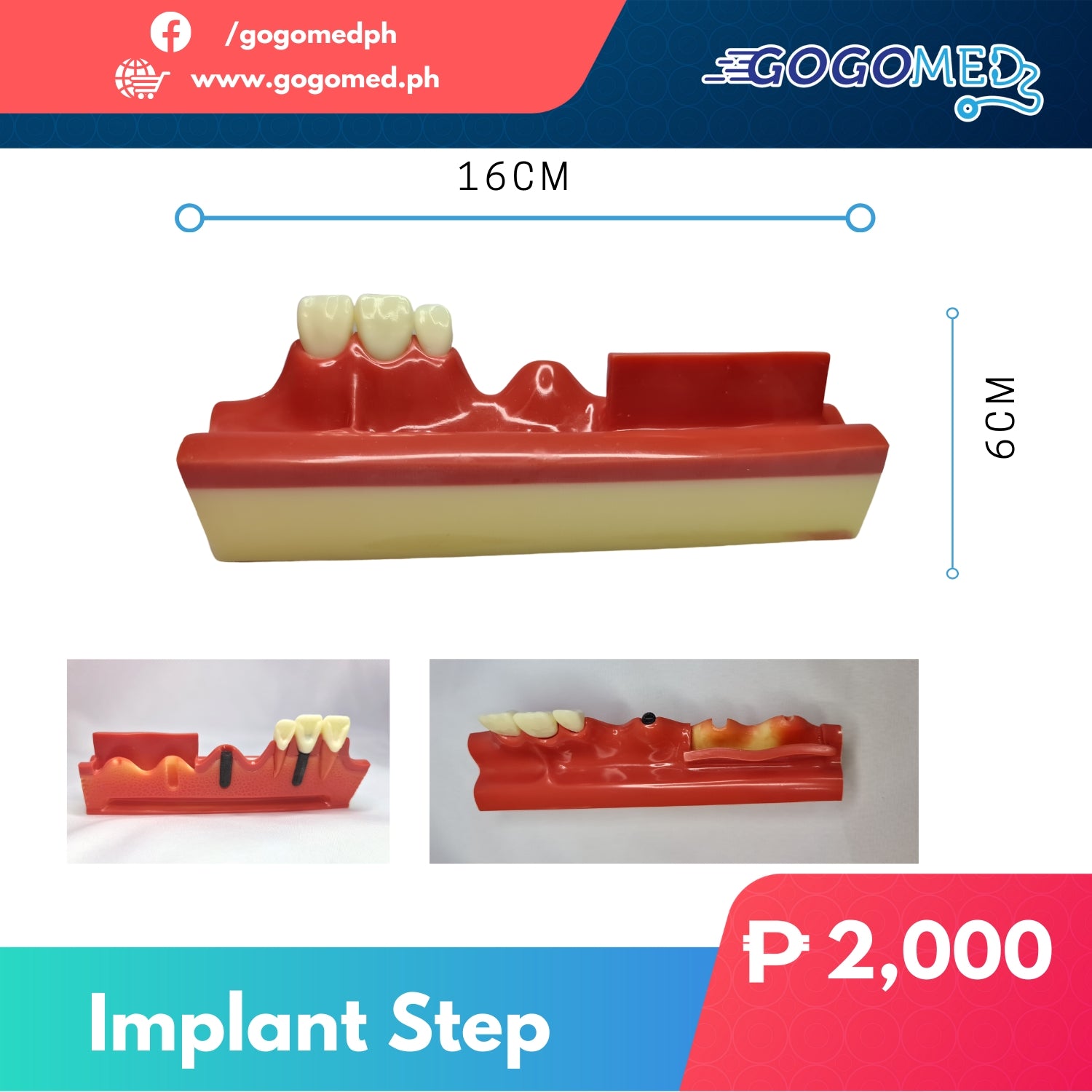 Implant Step - Gogomed Supplies