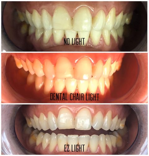 EZ Light Mobile Dental Photography - Gogomed Supplies